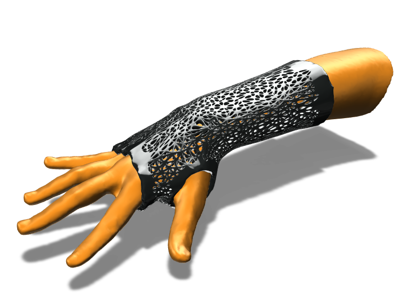 Arm splint with Voronoi perforation pattern - 3D design by ilmar3designs Dec 27, 2017 Arm splint with Voronoi perforation pattern - 3D design by ilmar3designs Dec 27, 2017